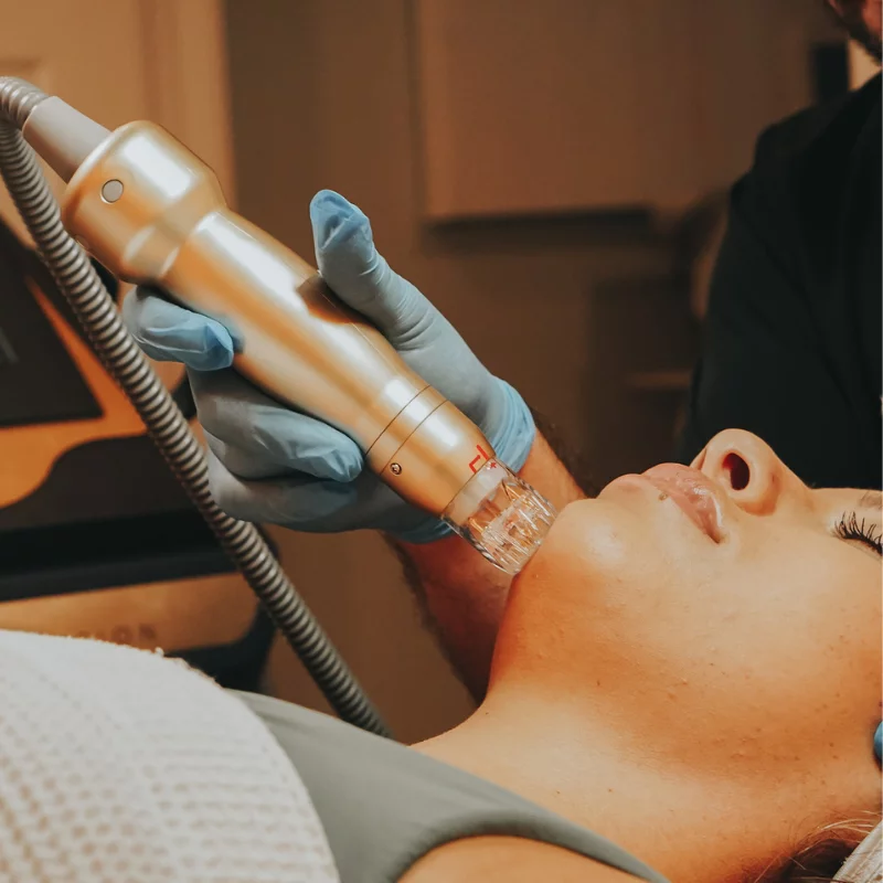 Microneedling MEDICAL SPA IN ORLANDO, FL