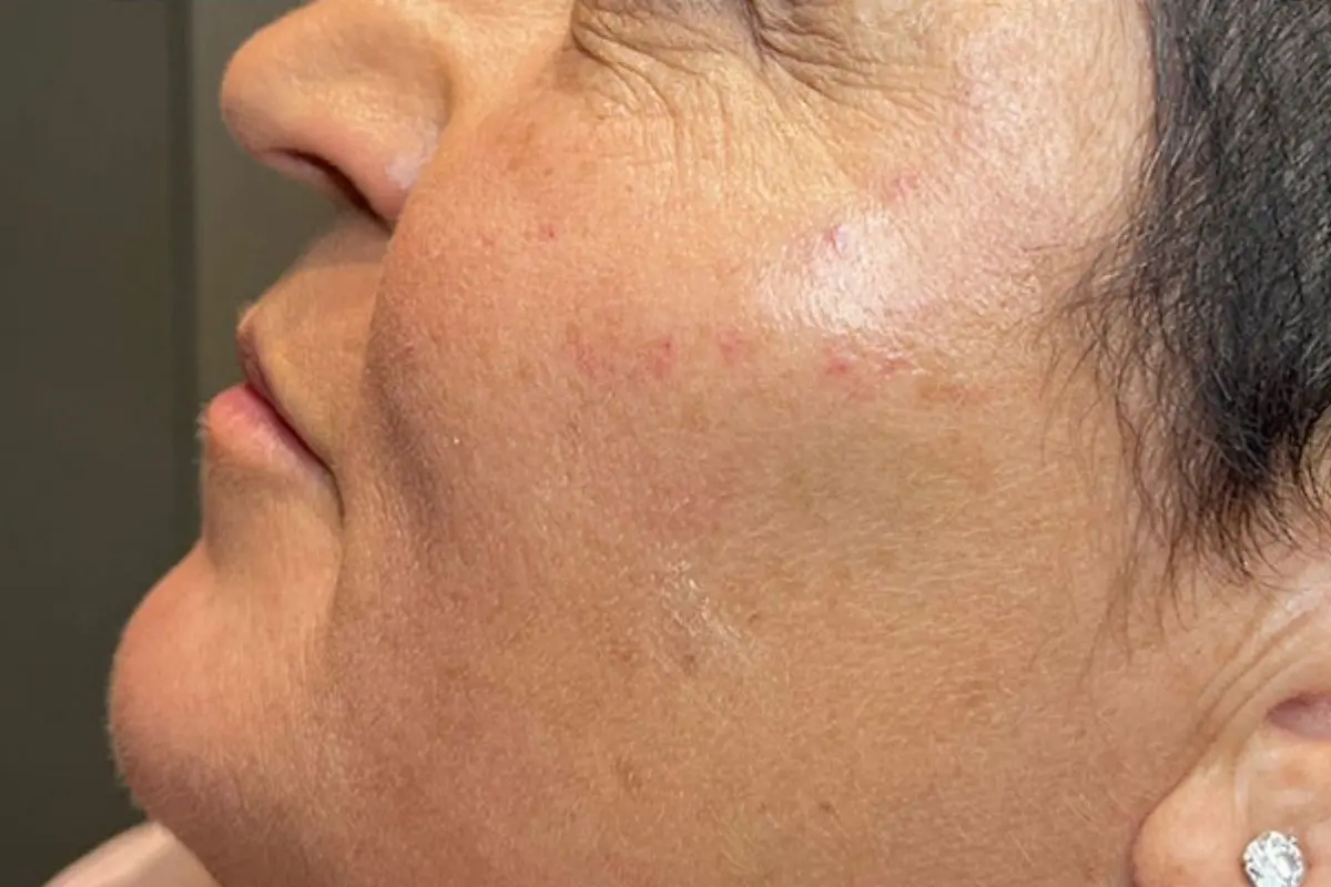 Cheek Skin Before Treatment