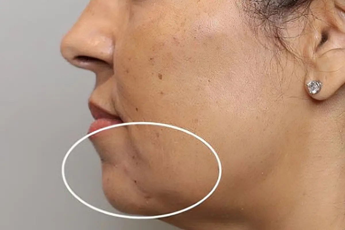Chin And Jawline Profile Before Treatment