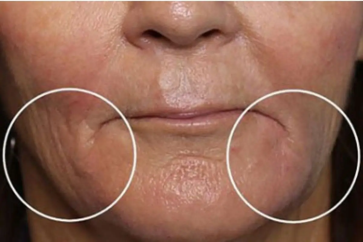 Marionette Lines Before Treatment