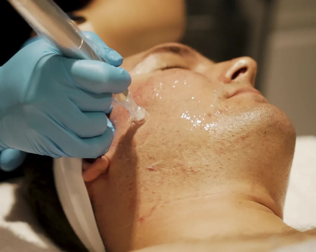 PRP with SkinPen microneedling at The Aesthetics Lounge and Spa Clinton Township